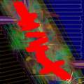 Intradural Tumors in Neonelectrometastasis